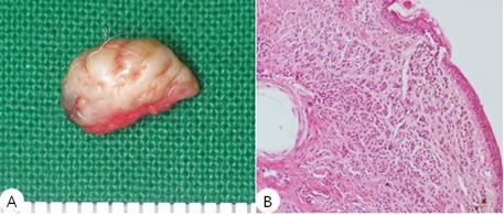 A Case of Papillomatous Compound Nevus of the Ear Canal