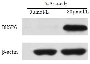Promoter Methylation of Dual Specificity Phosphatase-6 Gene effect on Invasion and Metastasis of Nasopharyngeal Carcinoma