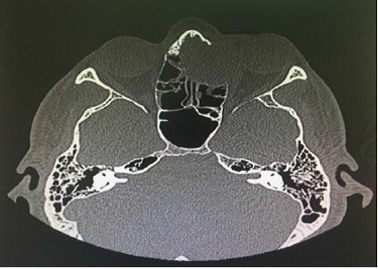 A Rare Case of Extra Nasopharyngeal Angiofibroma of the Ethmoid Sinus with Orbital Extension