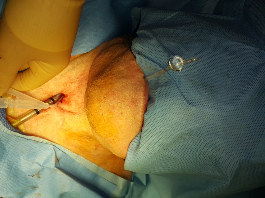 Stylet-Guided Secondary Tracheo-esophageal Puncture: A Safe and Simple Method