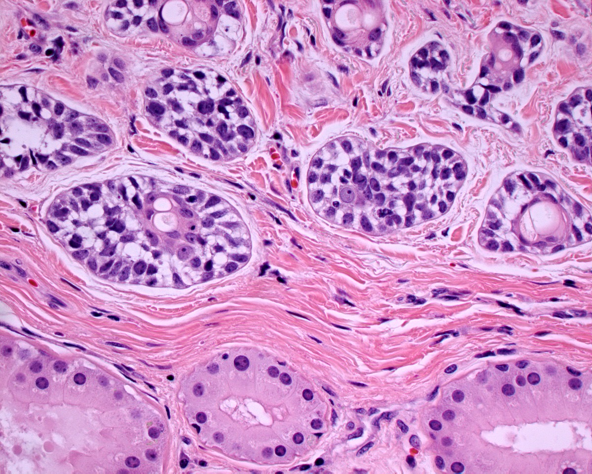 A New Treatment Option for Ceruminous Adenocarcinoma of External Auditory Canal