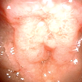 Progressive Velopharyngeal Insufficiency: A Rare presenting Symptom of Neurofibromatosis Type 1