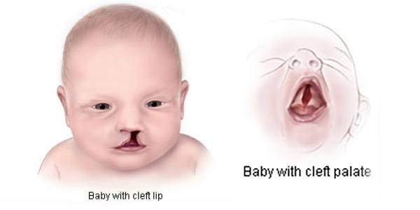 Maternal Experiences of Having a Child with a Cleft