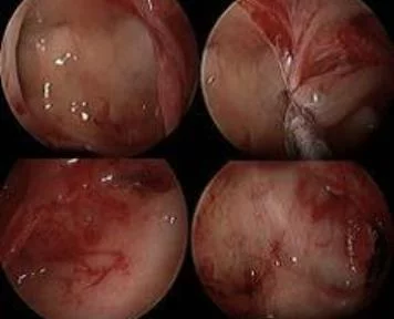Debride and Conquer: A New Angle in Endoscopic Removal of Antrochoanal Polyps