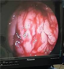 Trans-Oral Endoscopic Radio Frequency Adenoidectomy vs. Mirror Mono-Polar Adenoidectomy in Children: A Comparative Study