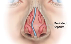 The Association of Nasal Septal Deviation with Solitary Sphenoidal Fungus Ball: Retrospective Analysis of 43 Patients