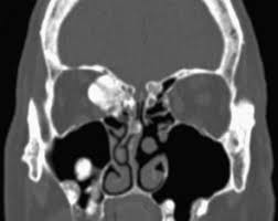 Unilateral Endoscopic Endonasal Resection of an Anterior Skull Base Osteoma Causing Tension Pneumocephalus
