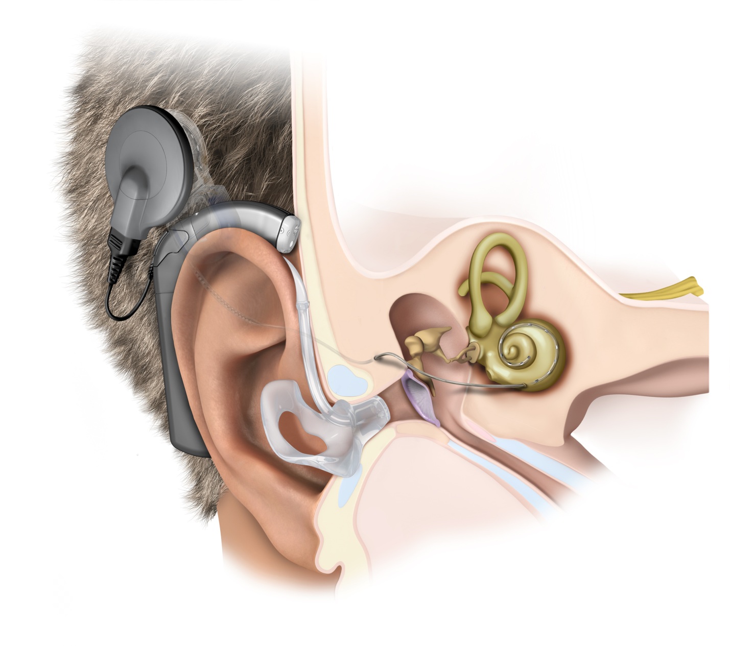 A Systematic Review of the Safety and Effectiveness of the Vibrant Soundbridge