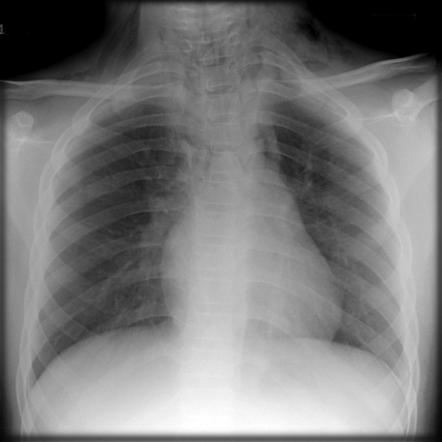 Case Report: Traumatic Pneumomediastinum Following Emesis Two Years After Laryngeal Fracture Repair