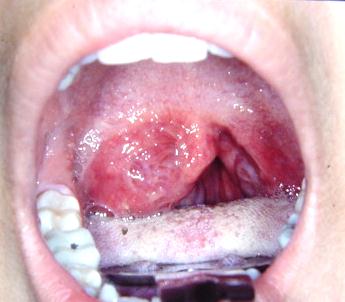 Bilateral Synchronous Tonsillar Carcinoma