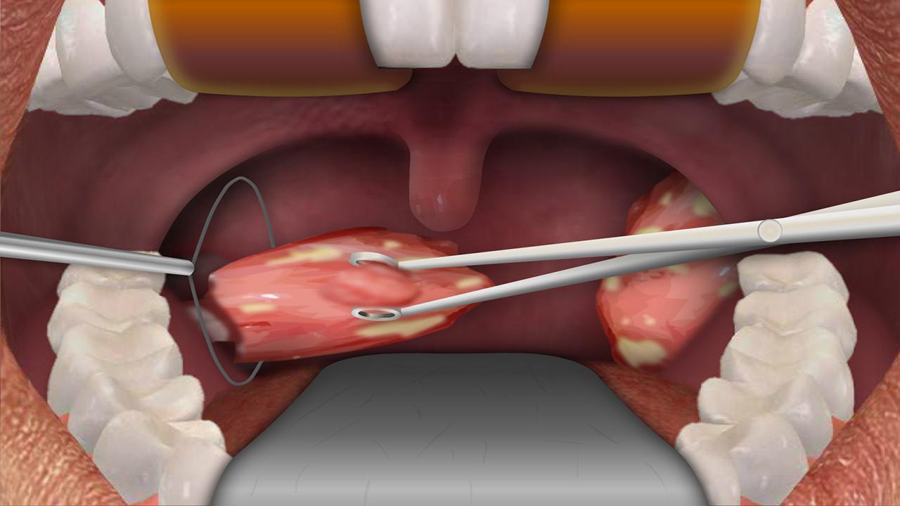 Post-Tonsillectomy Taste Disorders- Review of Literature