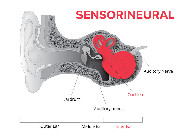 Sudden Sensorineural Hearing, a Possible Late Complication of COVID 19