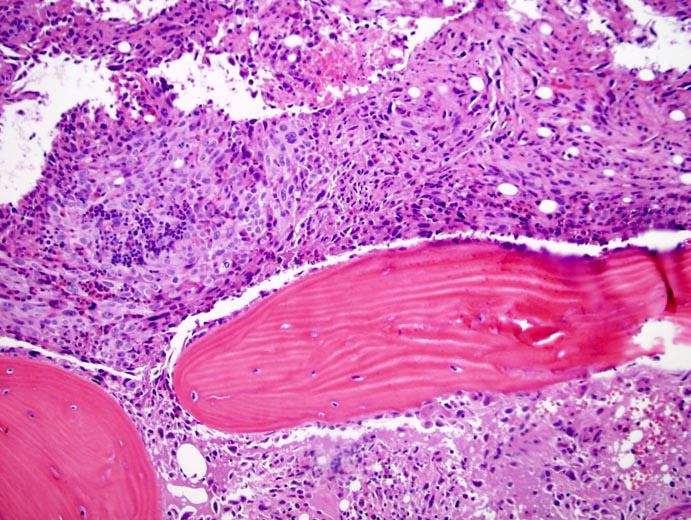 Primary Angiosarcoma of the Temporal Bone in a 55-year old Male with Audiovestibular Symptoms