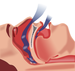 Combined Treatment of a Severe OSAS Patient Planned after a Sleep Endoscopy Performed with and without a Mandibular Protrusion Simulator. A Case Report