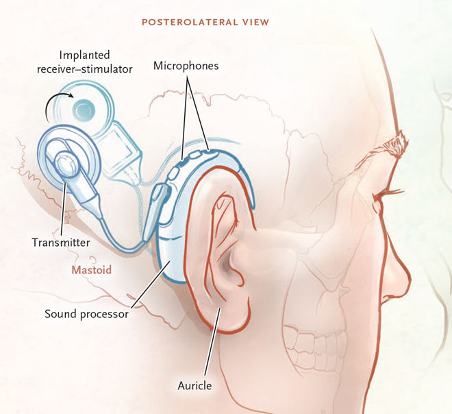 Cochlear Implantation for Hearing for the First Time