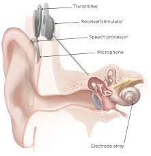 Customary Treatment for Hearing
Misfortune