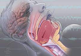 Sleep Apnea and its Overview