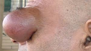 Concurrent Thyroglossal Duct Cyst and Dermoid Cyst in a Pediatric Patient