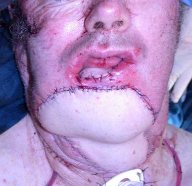 Transfusion of Aged Blood in Head and Neck Free Flap Surgery: Perioperative Outcomes Analysis