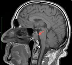 Lytic Lesion of the Clivus Following Intranasal Narcotic Abuse: First Case Report and Review of the Literature