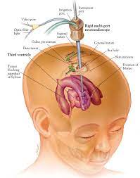 Skull Based Surgery and its Circumstances