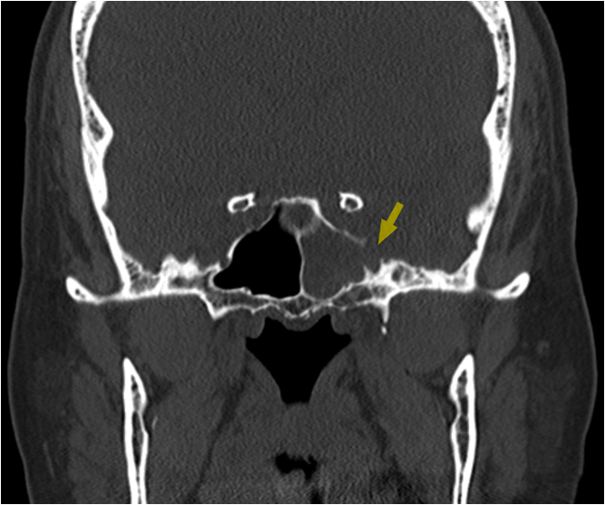 Cerebrospinal Fluid Leak from Lateral Sphenoid Sinus after Nasopharyngeal Swab Test for COVID-19: A Case Report and Review of Literature