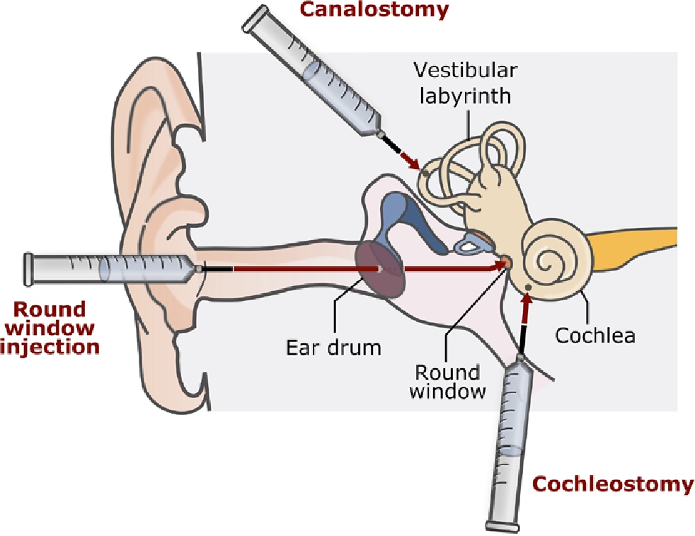 Hear-Able Neuropathy a Meeting Issue in the Inward Ear Effectively Distinguishes Sound