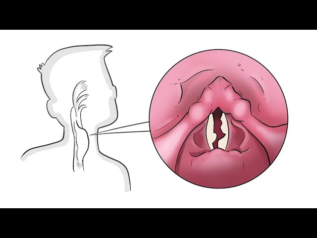 Vocal Line Granulomas are Spaces of Constant Irritation