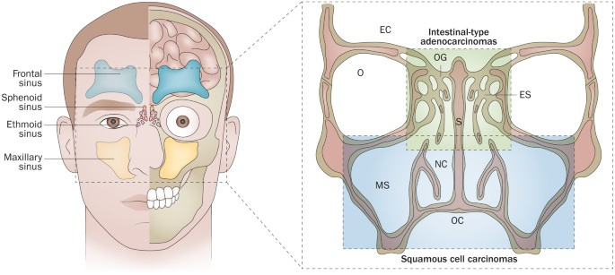 Essential Neoplasms of the Sphenoid Sinus