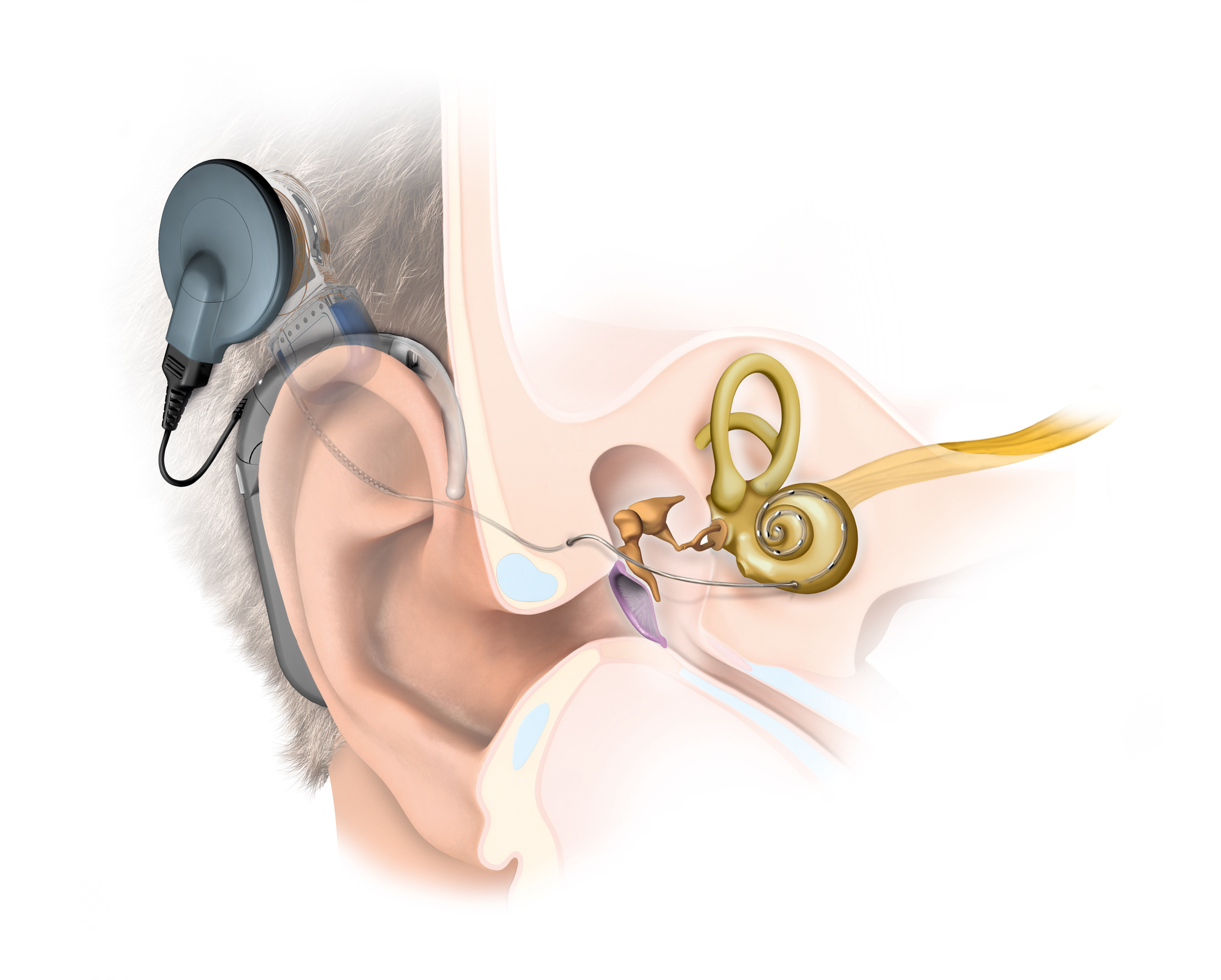 Cochlear Implant Obstruction in Radiation Oncology