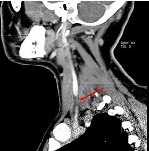 Lemierre Syndrome in a Healthy Patient: A Late Complication of Tonsillectomy?