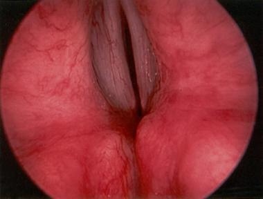 Reversibility of a Vocal Cord Palsy Following Fine Needle Aspiration Cytology of a Clinically Impalpable Thyroid Nodule