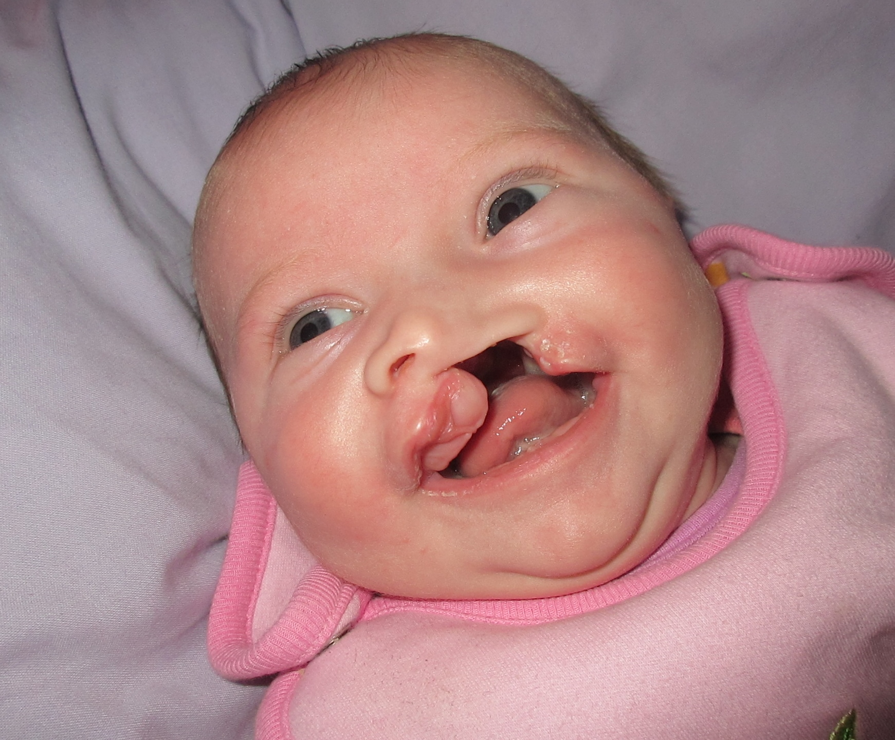 Management of Congenital Oral or Oropharyngeal Masses Resulting in Cleft Palate