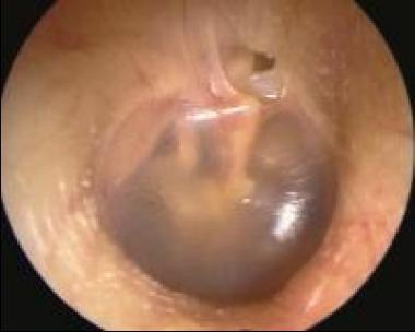 Management of the Facial Nerve in Complex Cases of Petrous Apex Cholesteatoma: Case Report