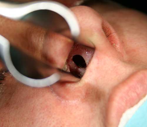 Endoscopic Repair of Nasal Septal Perforations Using Modified Pedicled Inferior Turbinate Flap