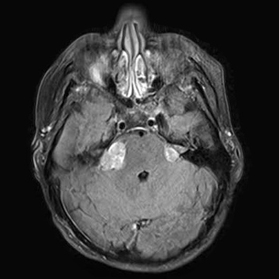 Neurofibromatosis Type-2 Presenting as a Giant Neck Mass and Hearing Loss