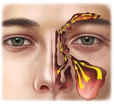 Endoscopic Resection of Maxillary Sinus Keratocystic Odontogenic Growths