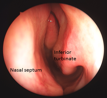 Does the Method of Inferior Turbinate Surgery Affect the Development of Empty Nose Syndrome?