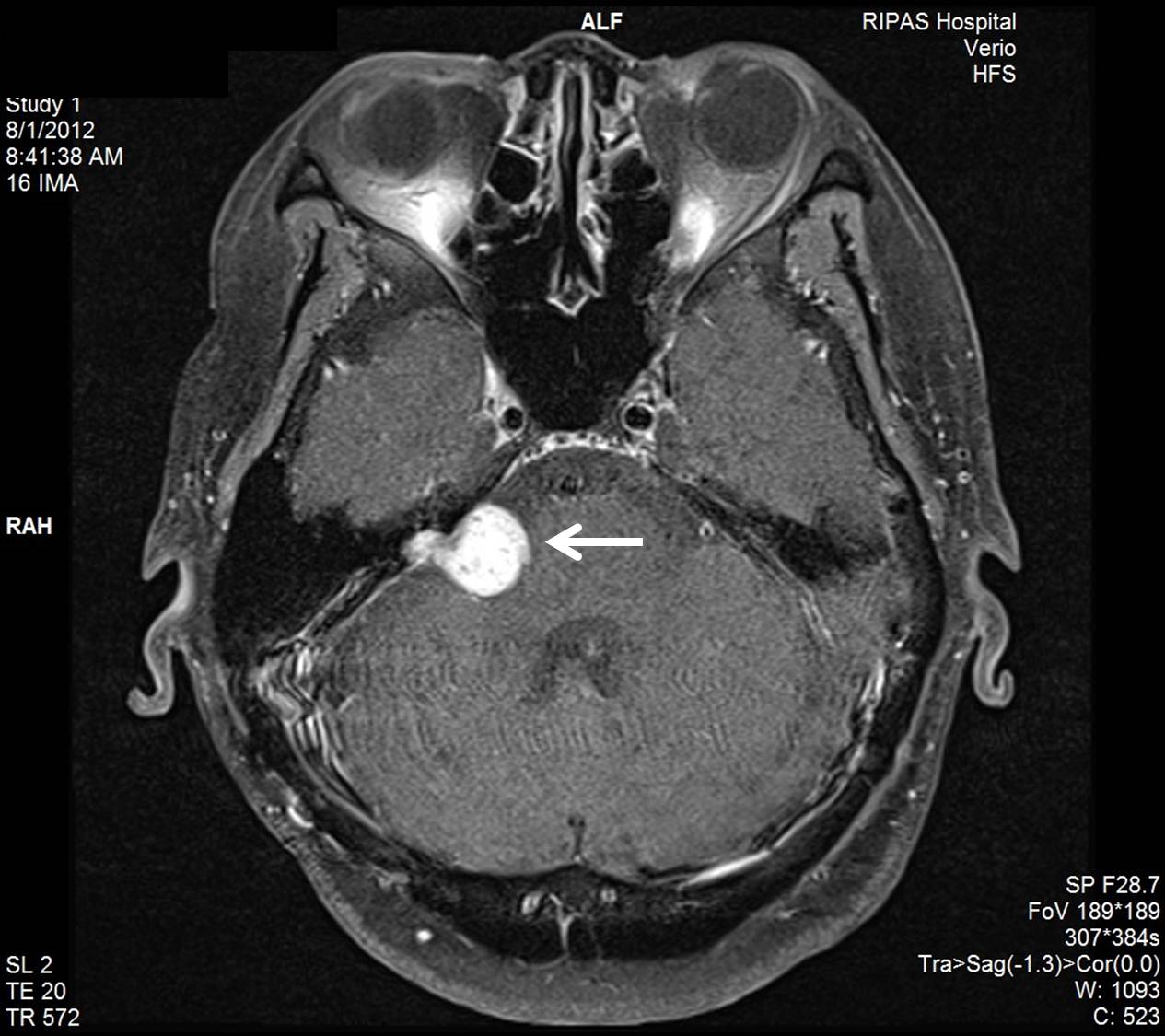 Single-sided Deafness with a Vestibular Schwannoma in the only Hearing Ear: Role of Cochlear Implantation