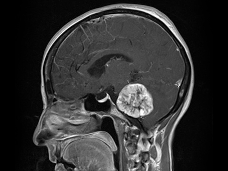 Spontaneous Size Regression of a Vestibular Schwannoma