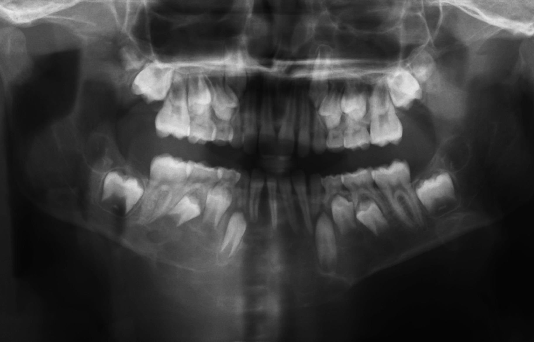 An Incidentally Discovered Radiolucency in the Posterior Maxilla