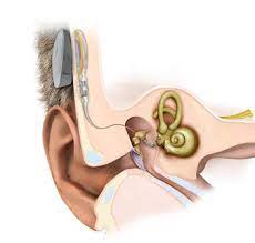 Effects of Residual Hearing on Cochlear Implant Outcomes in Children