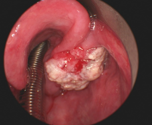 Efficacy and Safety of Sequential Chemoradiation with Docetaxel, Cisplatin, and
5-Fluorouracil (TPF) in Treating the Patients with Squamous Cell Carcinoma of the Hypopharynx: A Phase II Clinical Trial