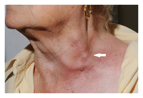 Lateral sinus, Transverse Sinus and Jugular Vein Thrombosis as a Rare Complication of Chronic
Mastoiditis