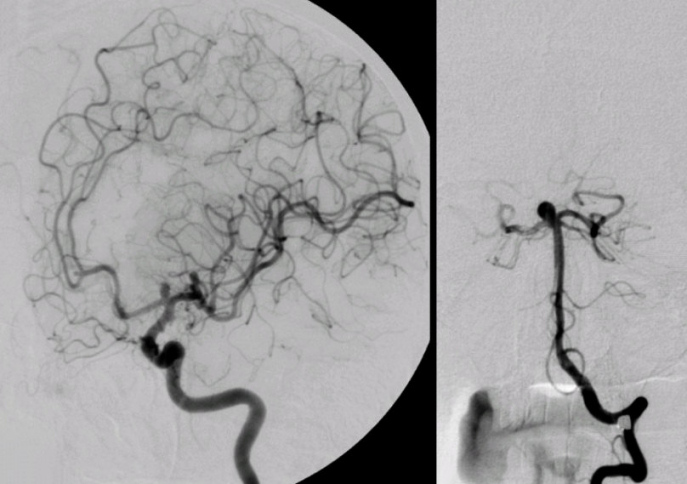 Intracavernous Carotid Aneurysm Mimicking Pituitary Adenoma: An Insidious Surgical Trap