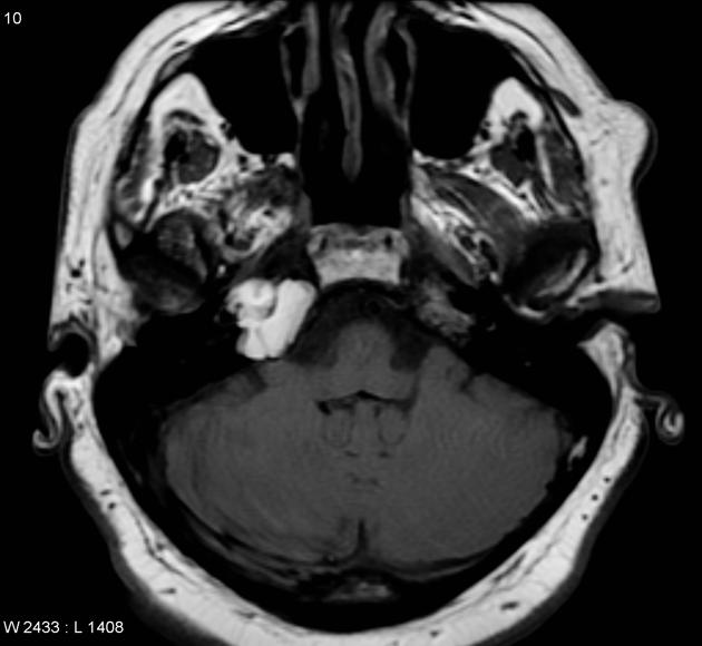 Endoscopic Transsphenoidal Approach to Petrous Apex Cholesterol Granuloma