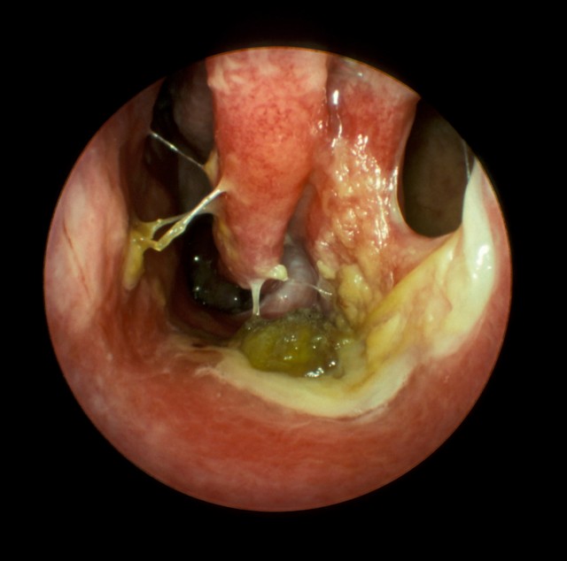 Atrophic Rhinitis - Empty Nose Syndrome: A Clinical, Endoscopic and Radiological Entity