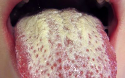 Epitheloid Sarcoma of the Tongue