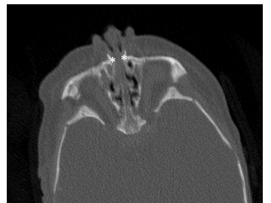 Is There a Role for Non-Operative Management of Congenital Nasal Pyriform Aperture Stenosis
(CNPAS)?