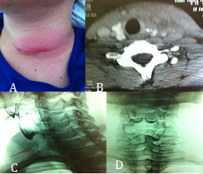Case Report: Recurrent Thyroid Abscess Secondary to the Fistula of Pyriform Recess